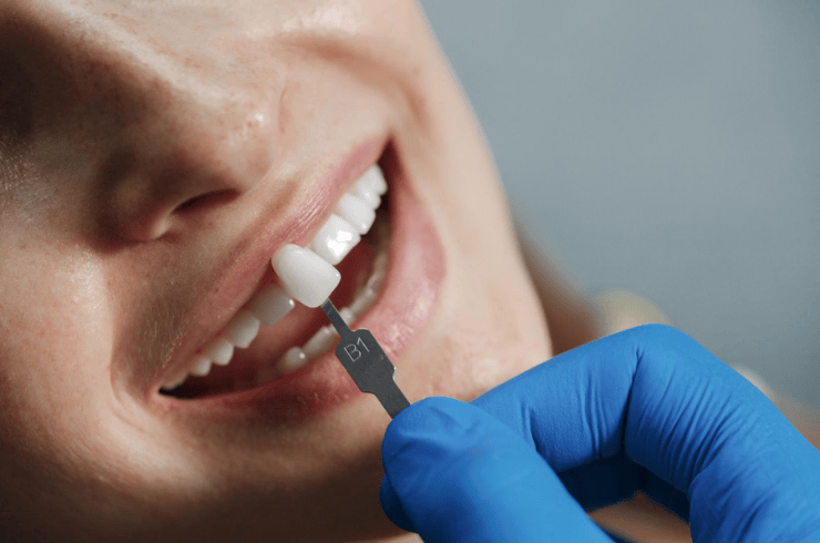 Teeth Replacement