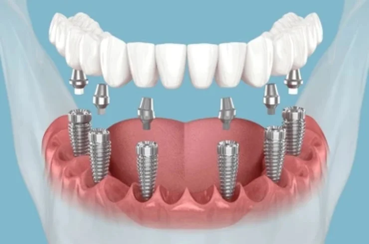 Dental Implants-03