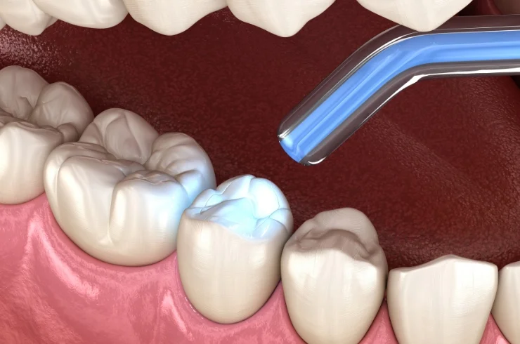 Fillings